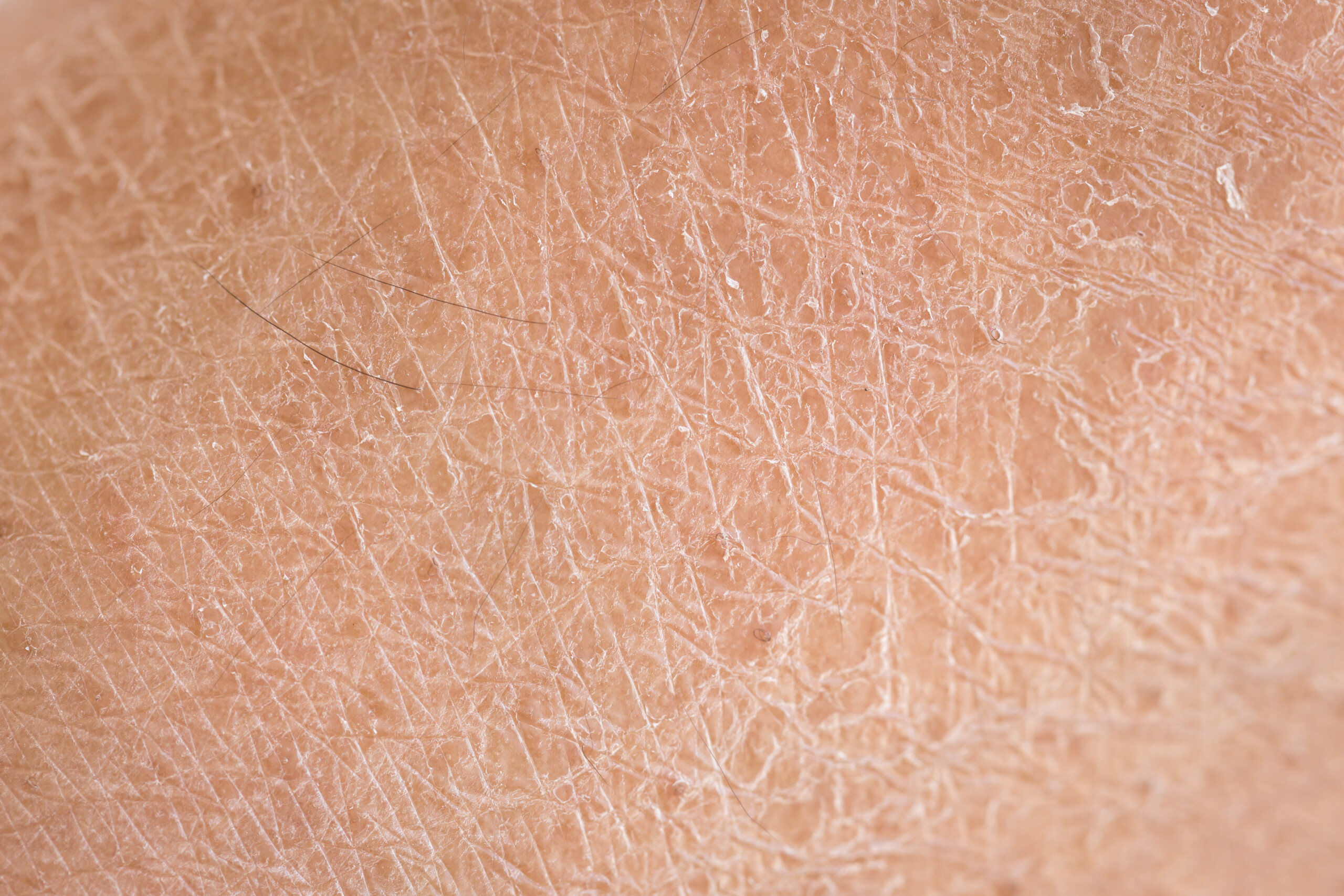 Macro dry skin (ichthyosis) detail